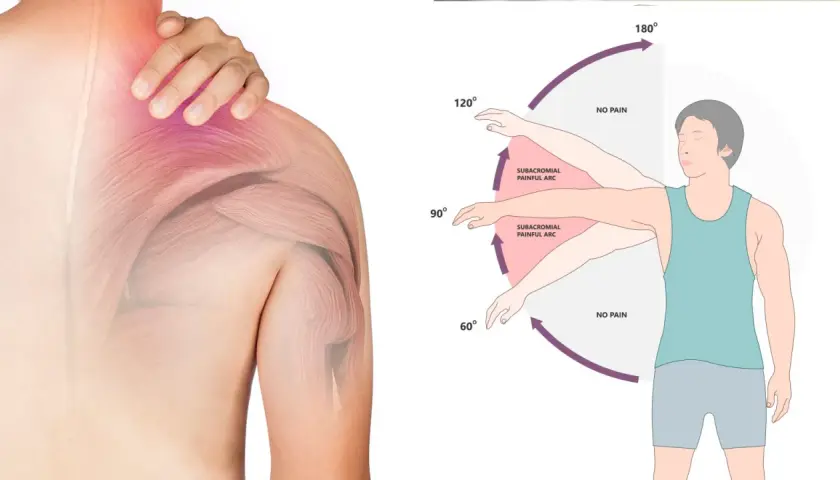 Illustrazione anatomica della spalla con dolore e diagramma che mostra gli esercizi per la spalla congelata, evidenziando l'arco doloroso.