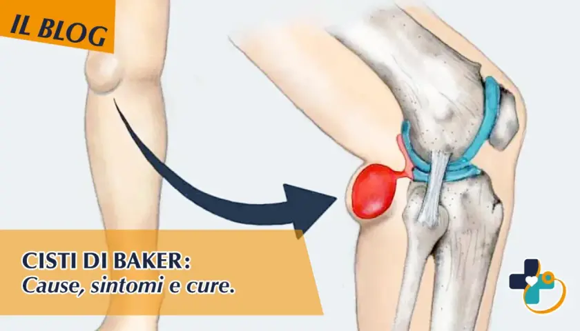 Illustrazione anatomica di una cisti di Baker nel ginocchio, con indicazioni su cause, sintomi e cure. I tempi di guarigione variano.