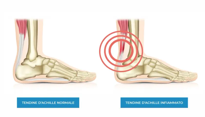Confronto tra tendine d'Achille normale e infiammato. L'immagine mostra un piede con scheletro e muscolatura, evidenziando la differenza tra un tendine sano e uno irritato con cerchi rossi.
