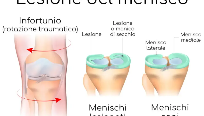 Illustrazione che mostra cos'è un menisco e le lesioni a manico di secchio, con menischi sani e lesionati.