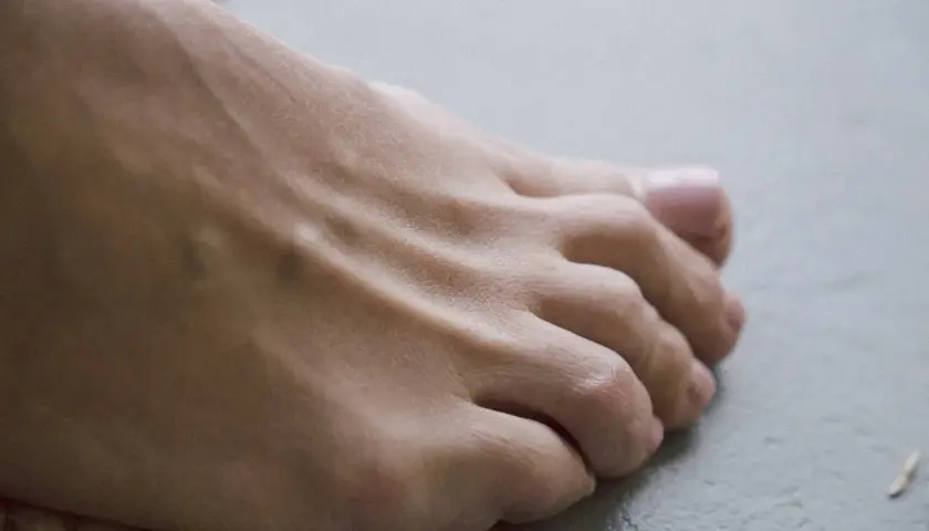 Piedi con gonfiore e arrossamento, possibili sintomi iniziali di artrite reumatoide.