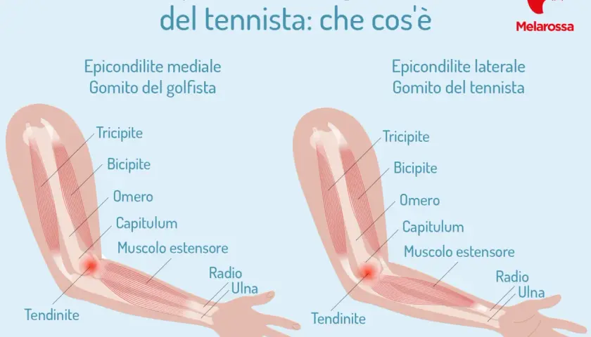 Illustrazione anatomica che spiega epicondilite, o gomito del tennista, e epicondilite mediale, o gomito del golfista.