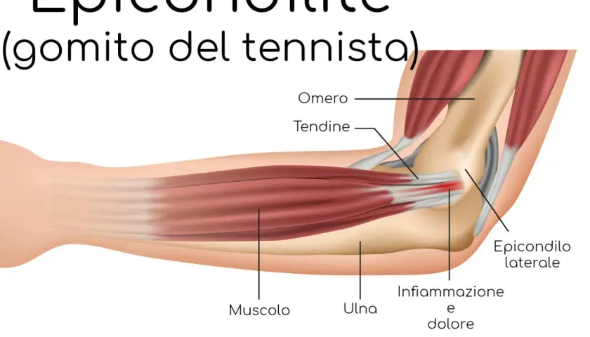 Illustrazione anatomica del gomito che mostra infiammazione e dolore, causa comune del dolore avambraccio tennis.