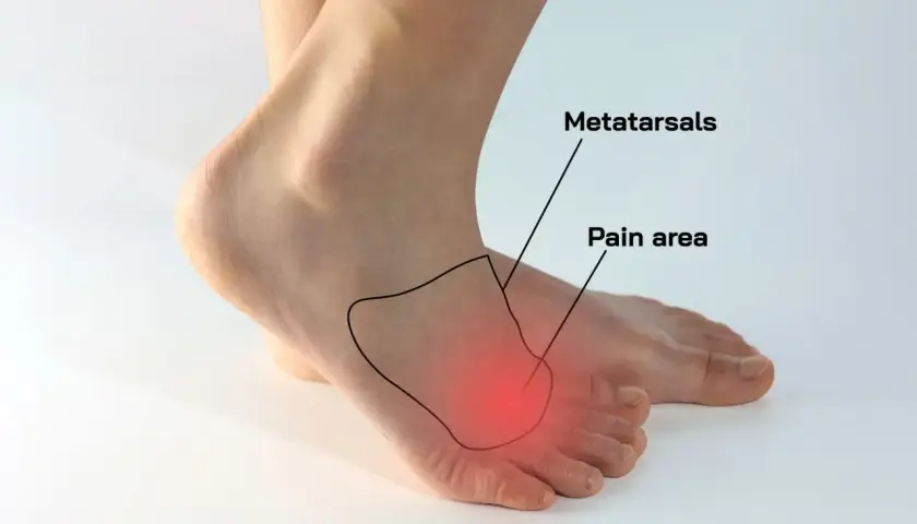 Area dolente del metatarso, indicata per capire come sfiammare il neuroma di Morton.