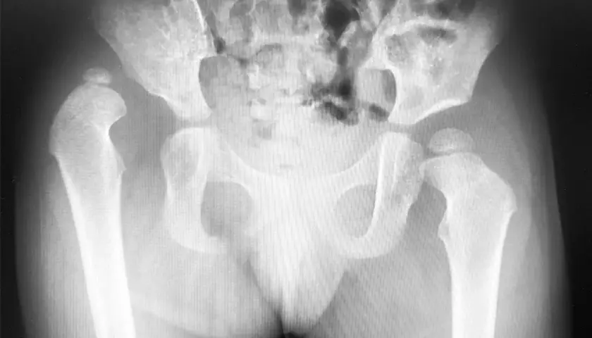 Radiografia del bacino e delle anche. Si nota una lussazione dell'anca, con implicazioni sui tempi di recupero.