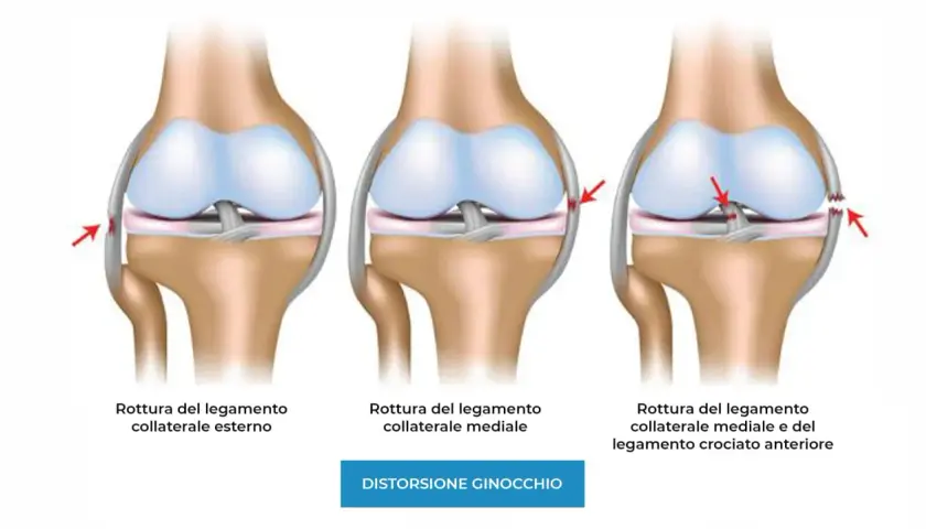Illustrazione di ginocchia con lesioni ai legamenti: rottura del legamento collaterale esterno, mediale e crociato anteriore.