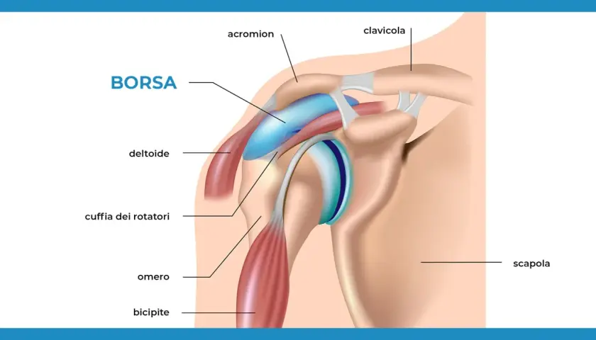 Illustrazione anatomica della spalla con etichette. Si vede la borsa, il deltoide, la cuffia dei rotatori, l'omero, il bicipite, l'acromion, la clavicola e la scapola.