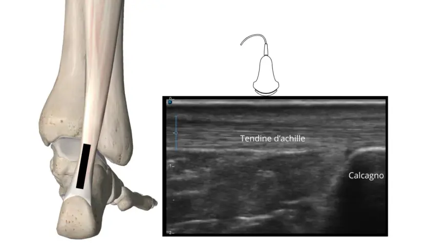 Ecografia del tendine d'Achille con evidenza di infiammazione. Anatomia e immagine ecografica.