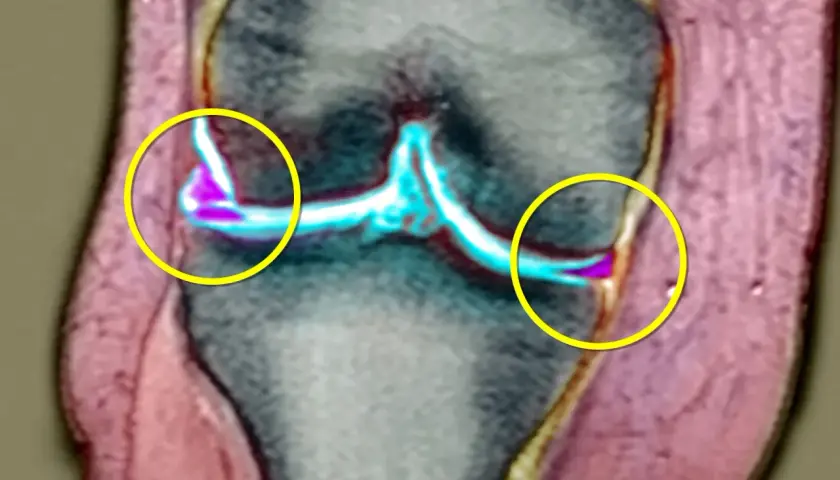 Risonanza magnetica del ginocchio evidenzia una lesione meniscale senza gonfiore, con aree di alterazione colorate in viola e blu.
