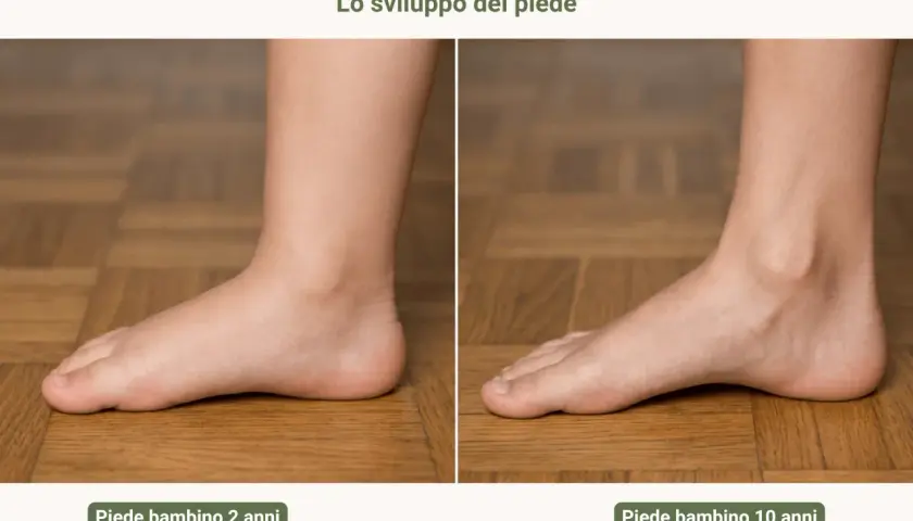 Confronto tra piede valgo di un bambino di 2 anni e di 10 anni, mostrando l'evoluzione della volta plantare.