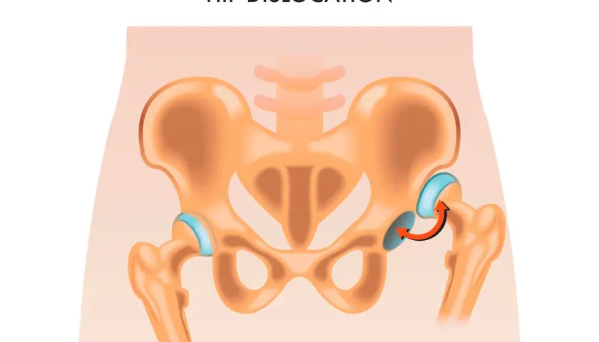 Illustrazione anatomica che mostra una lussazione dell'anca, con la testa del femore fuori dall'acetabolo.
