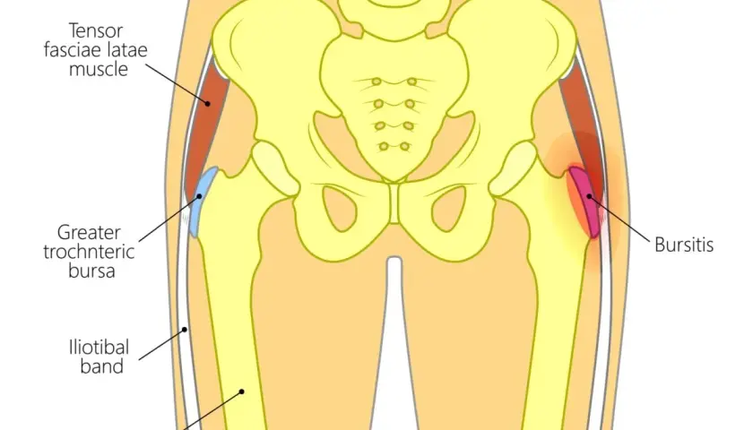 Illustrazione anatomica dell'anca che mostra la borsite trocanterica. Suggerimenti su come dormire con il dolore.