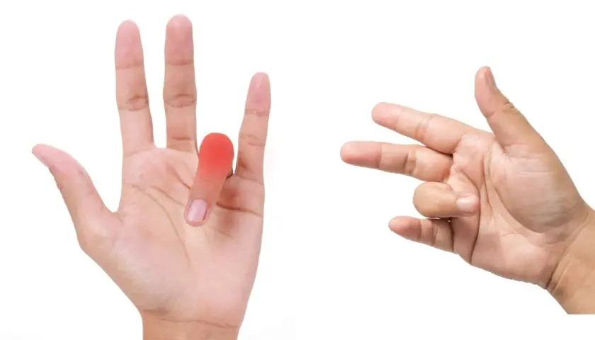 Mano con dito a scatto evidenziato in rosso, accanto a un'altra mano che esegue esercizi per il dito.