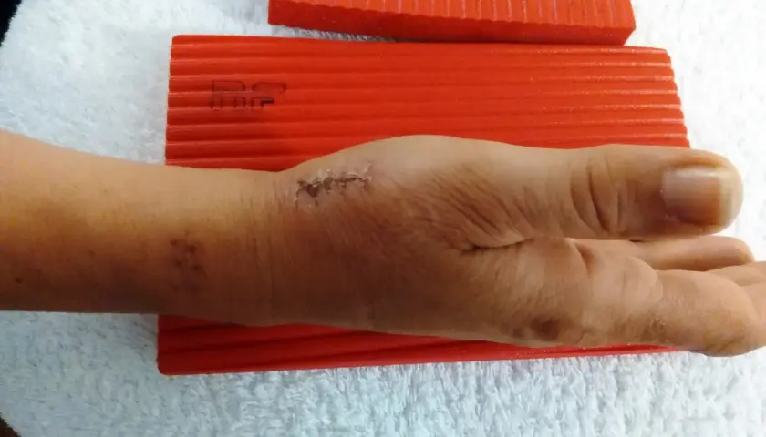 Mano con segni di sutura e taping per rizoartrosi pollice, appoggiata su asciugamano bianco con blocchi rossi.