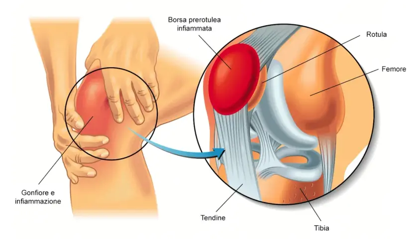 Ingrandimento di un ginocchio con gonfiore e infiammazione. La borsite al ginocchio è evidenziata, mostrando la borsa prerotulea infiammata.