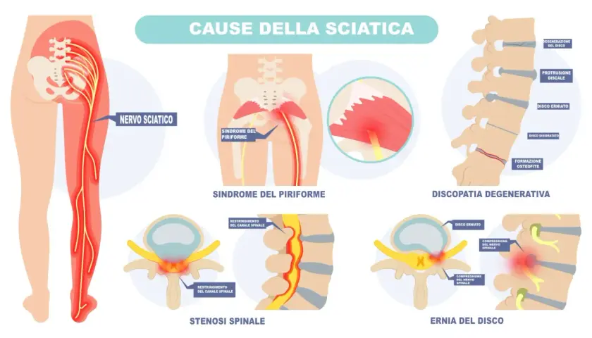 Illustrazione delle cause della sciatica: sindrome del piriforme, discopatia degenerativa, stenosi spinale ed ernia del disco, che provocano dolore al nervo sciatico.