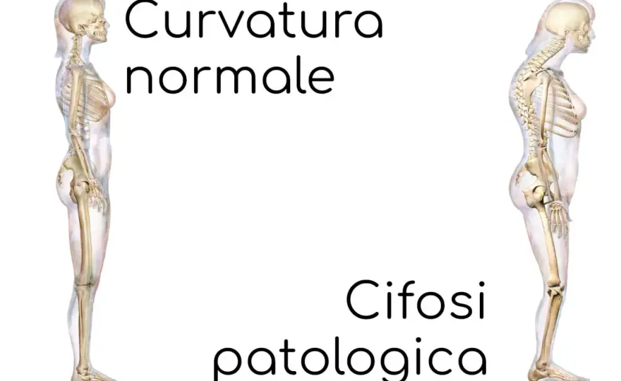 Cifosi lombare - cause, diagnosi e trattamenti