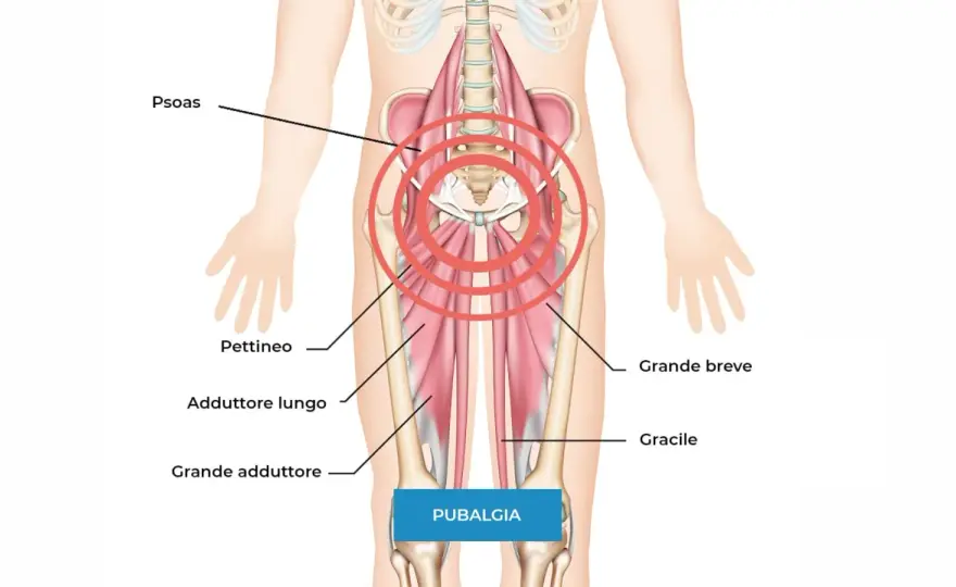 Come curare la pubalgia velocemente e tornare allo sport