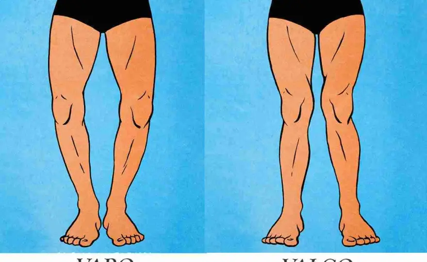 Ginocchio valgo o varo? Differenze, cause e quando farsi vedere