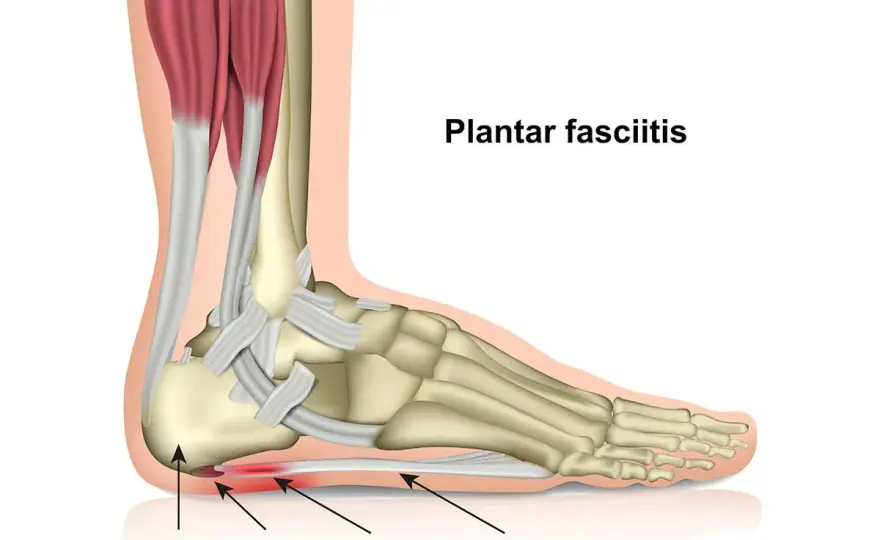 Fascite plantare e magnesio - cosa aiuta davvero?
