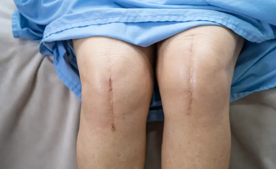Scollamento della protesi di ginocchio - segnali e diagnosi