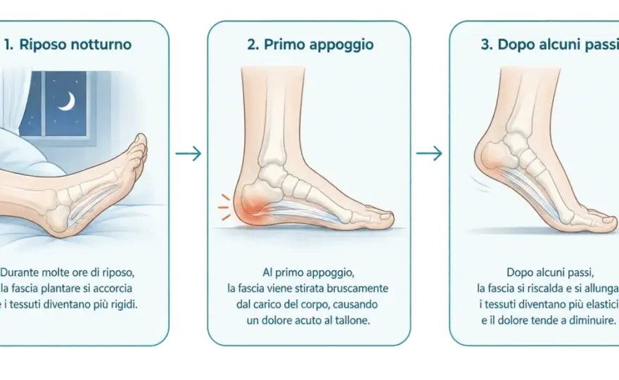 Fascite plantare che non passa - cosa fare e quando farsi visitare