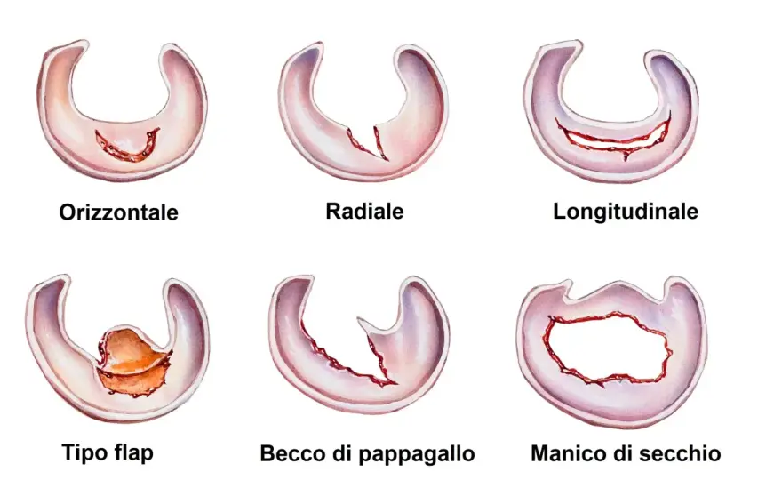 Menisco rotto - sintomi, diagnosi e quando serve operare
