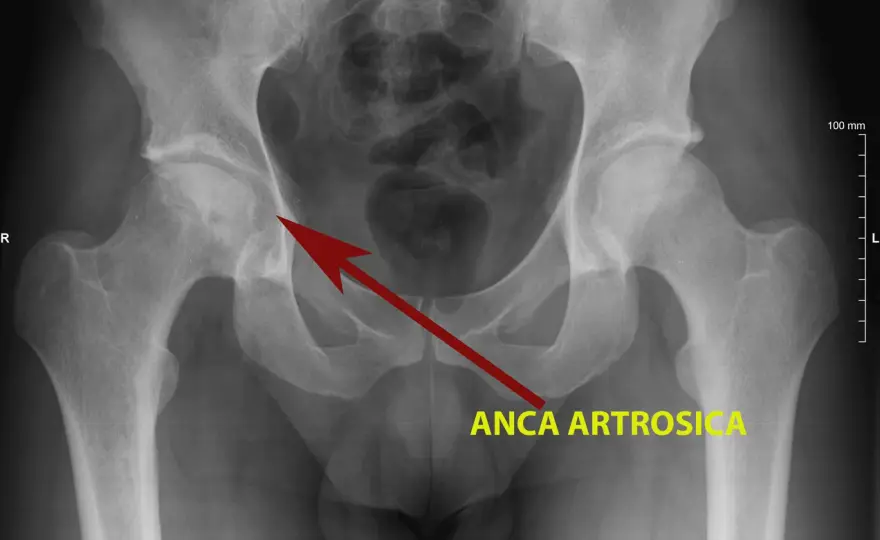 Artrosi dell’anca - sintomi, diagnosi e cosa aiuta davvero