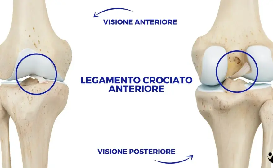 Crociato rotto? Sintomi, diagnosi e quando operarsi