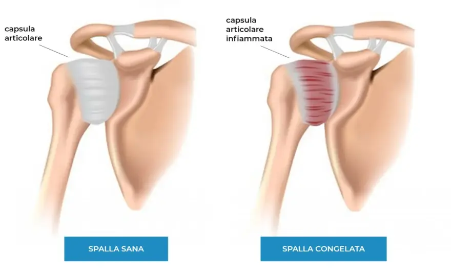 Clavicola infiammata - sintomi, cause e quando farsi visitare