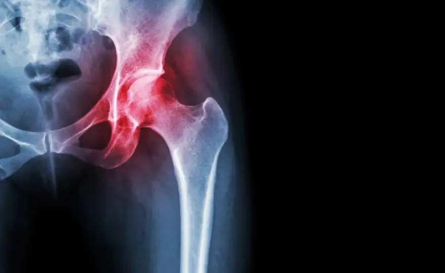 Trocanterite, camminare fa bene? Come dosare il carico