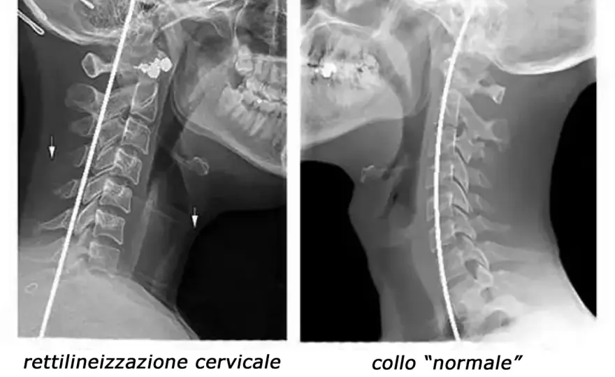 Rettilineizzazione cervicale - cosa significa e quando preoccuparsi