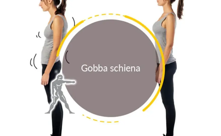 Gobba sulla schiena - cause, esami e segnali d'allarme