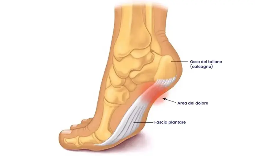 Dolore al tallone come spilli - cause e cosa fare