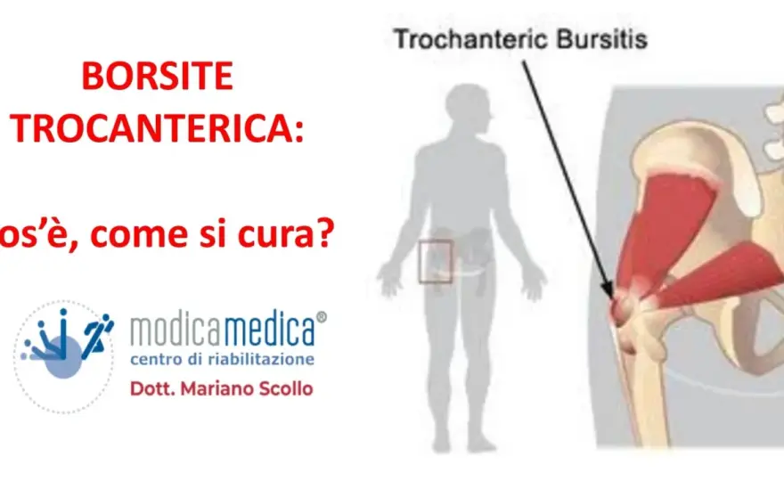 Borsite trocanterica che non passa? Cause e cosa fare