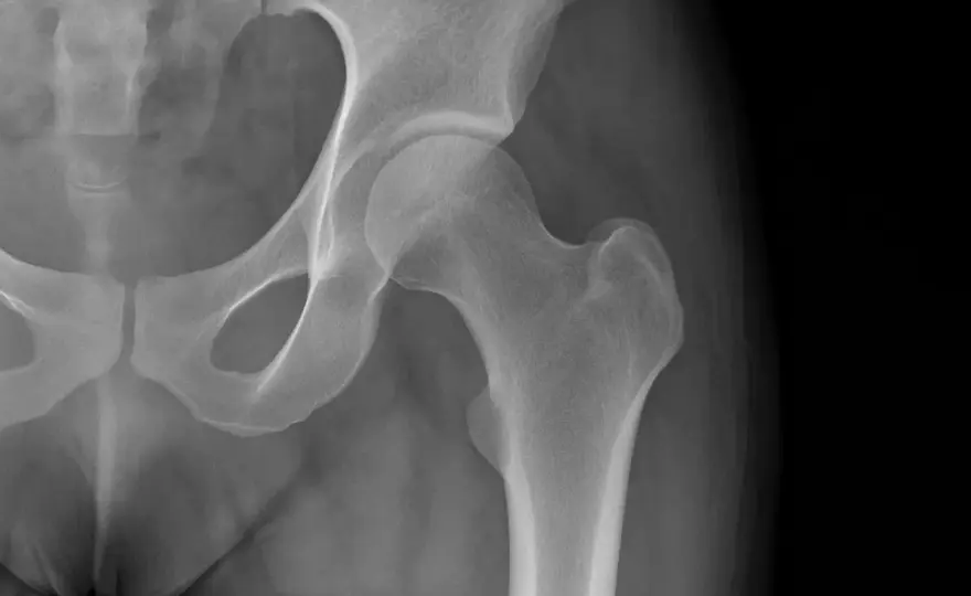 Calcificazione dell’anca - sintomi, esami e cure