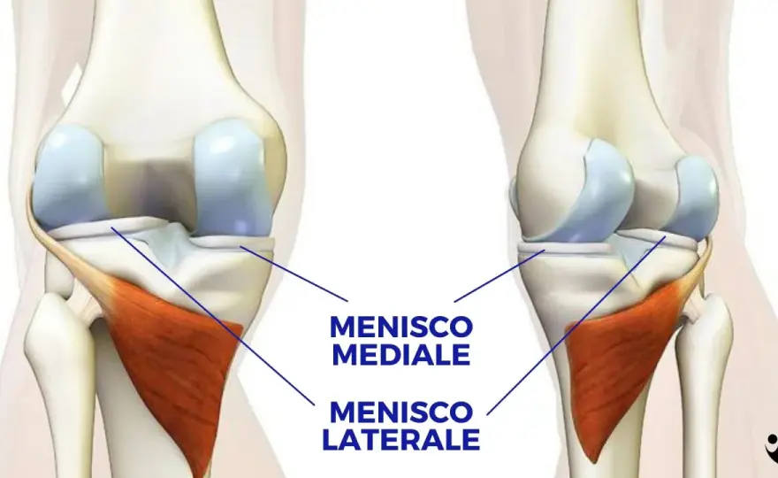 Meniscopatia mediale - sintomi, cura e quando operare