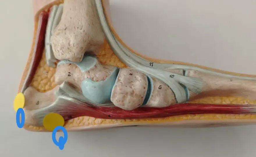Sperone calcaneare trascurato? Cosa può succedere e cosa fare