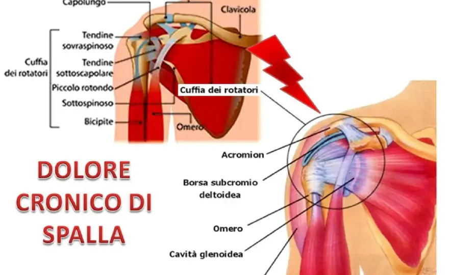 Dolore alla spalla destra quando sollevi il braccio
