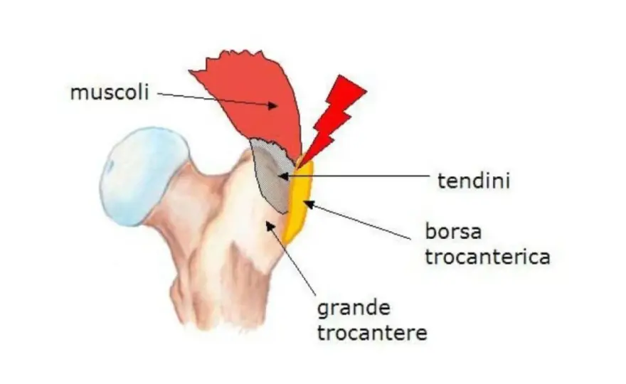 Grande trocantere - dove si trova e quando fa male