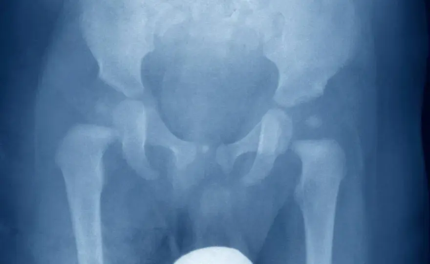 Osteocondrosi dell’anca nei bambini - sintomi e cure
