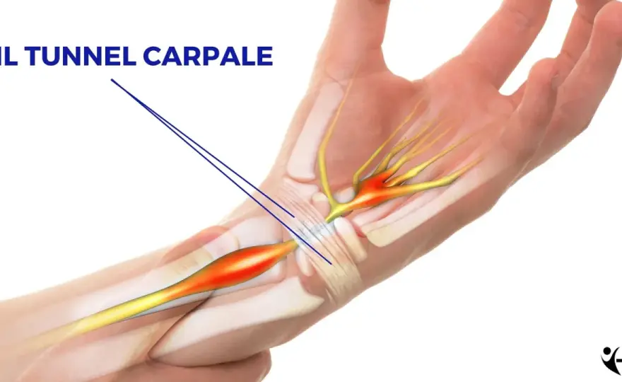 Chirurgia del tunnel carpale - quando serve e come recuperare