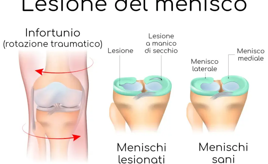 Menisco del ginocchio - sintomi, diagnosi e cure