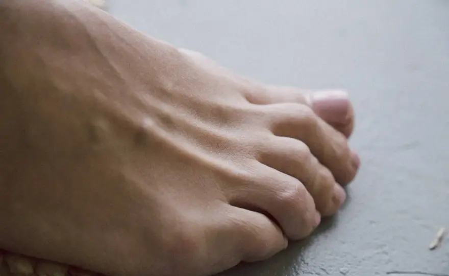 Artrite reumatoide ai piedi - i segnali da non ignorare