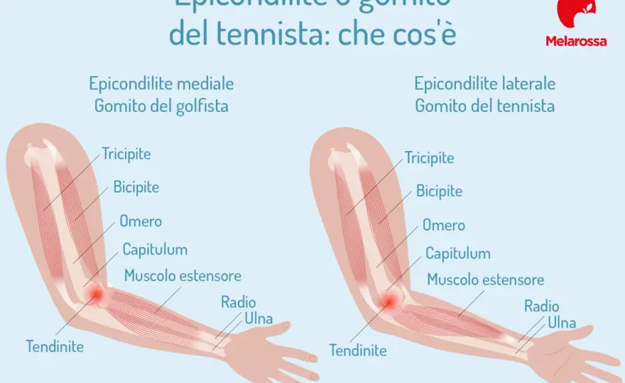 Epicondilite - sintomi, cause e recupero dal gomito del tennista