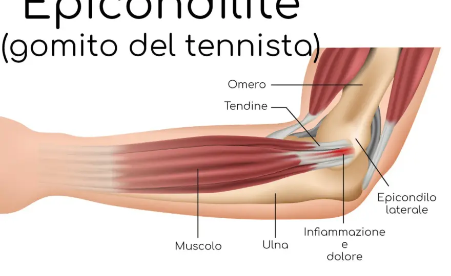 Dolore all’avambraccio nel tennis? Cause, esercizi e rientro