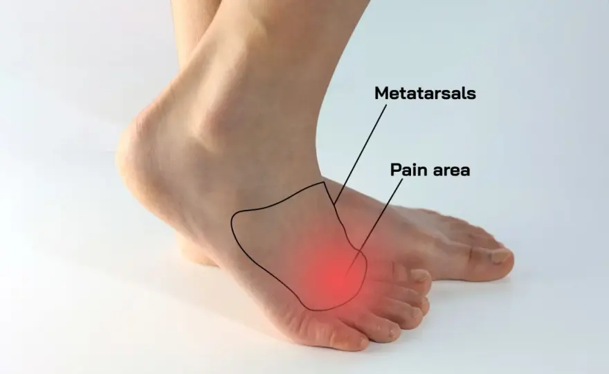 Come sfiammare il neuroma di Morton e quando farsi visitare