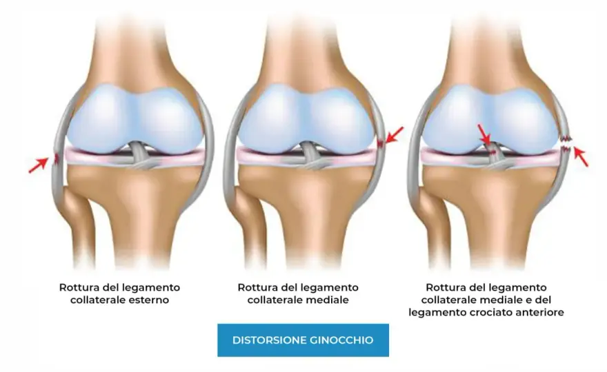 Legamenti del ginocchio, lesioni e recupero