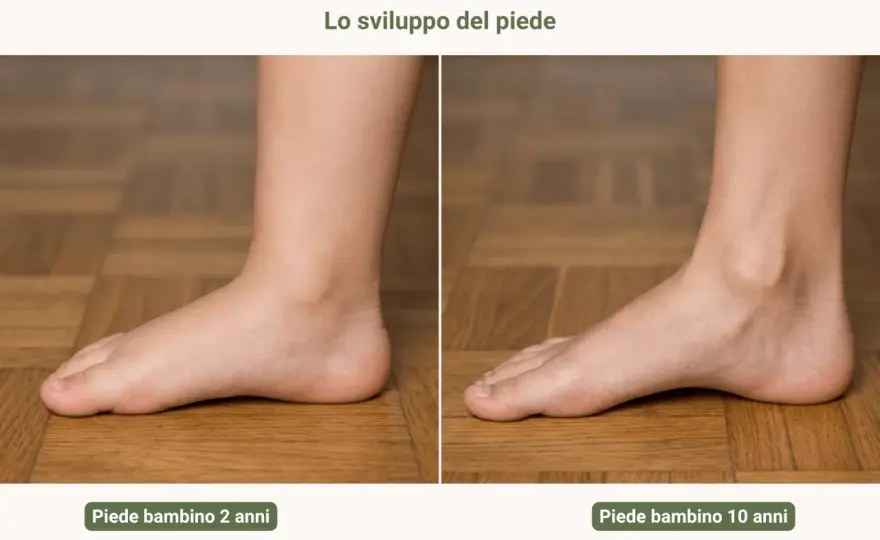 Piede valgo e piede piatto - quando preoccuparsi?