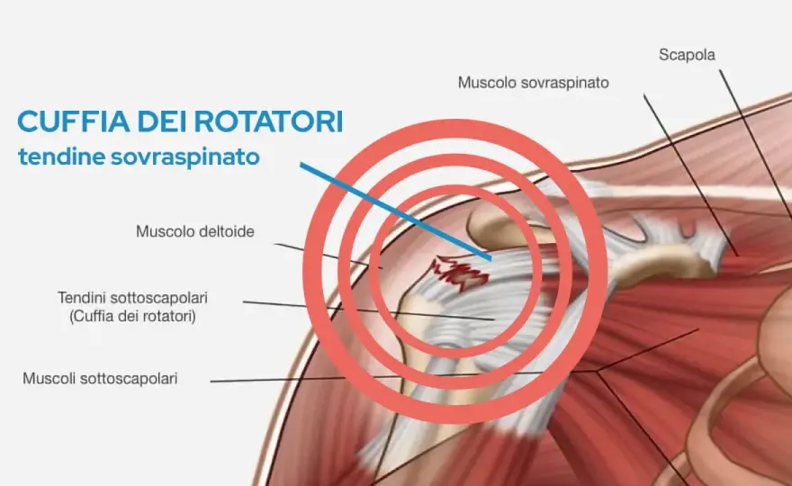 Cuffia dei rotatori infiammata? Sintomi e cure